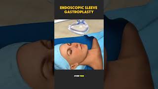 Endoscopic Sleeve Gastroplasty (3D Animation) #endoscopicsleevegastroplasty #sleeve #flexible #banan