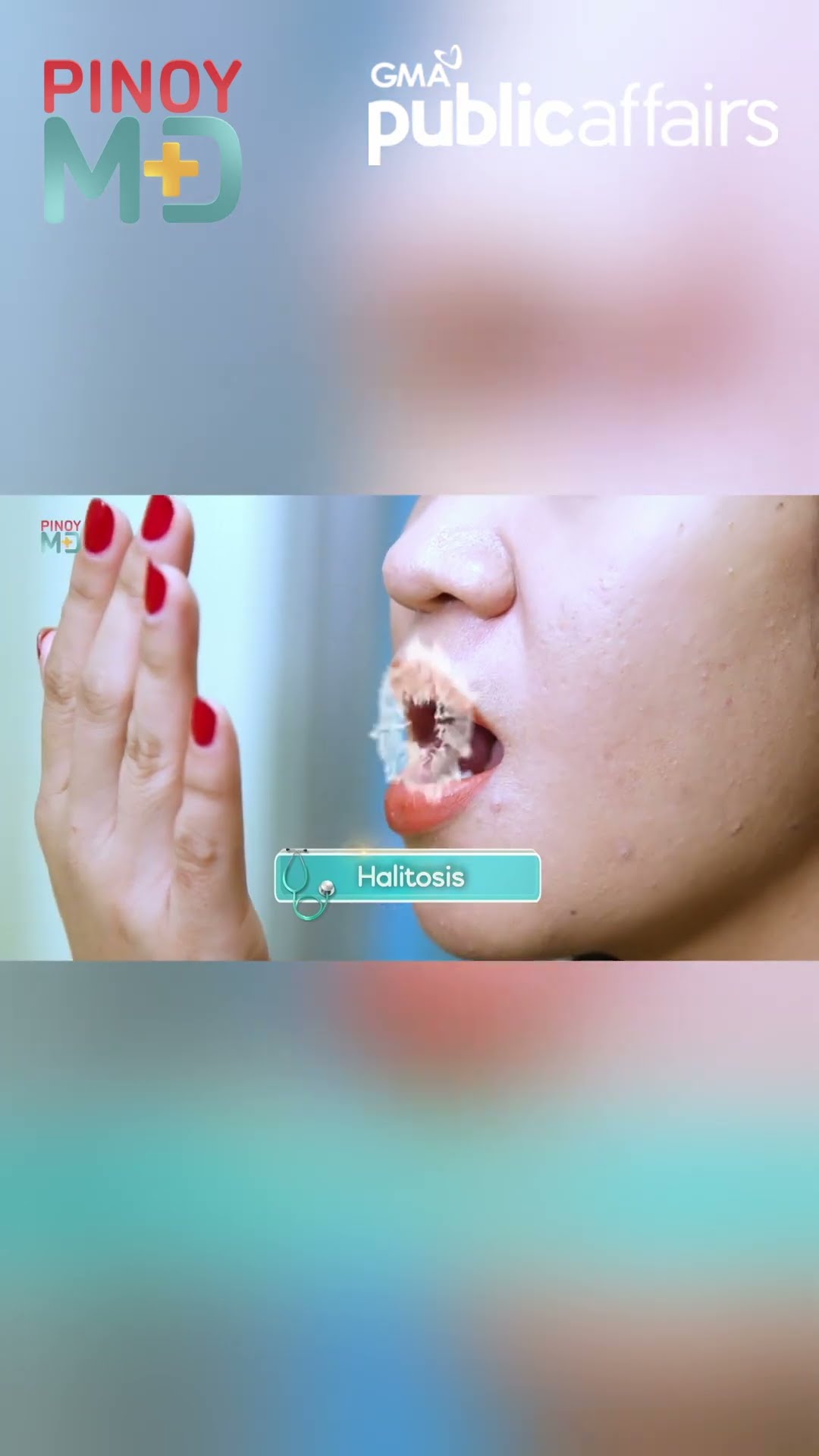Ano ang sintomas ng tonsil stones? | Pinoy MD