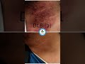 #skindoctor #dermatologist #dermatitis #eczema #skincare