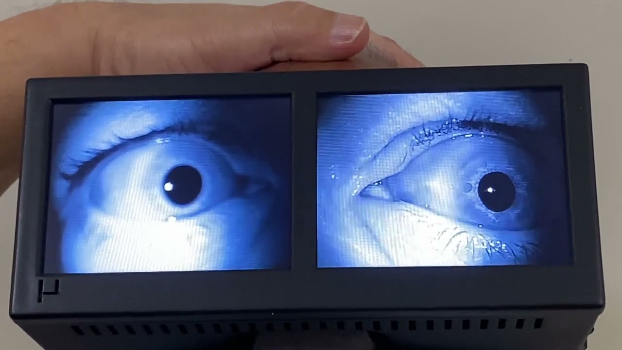 Bow and Lean Test for Right Horizontal Semicircular Cupulolithiasis