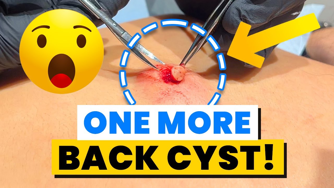 ONE MORE BACK CYST! YouTube