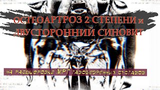 ОСТЕОАРТРОЗ тазобедренного сустава 2 СТЕПЕНИ и двусторонний СИНОВИТ на РАСШИФРОВКЕ МРТ тазобедренных
