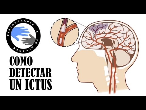 Como detectar un ictus o acv en menos de un minuto Detecta un ictus en solo un minuto: síntomas y consejos