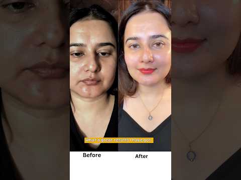 Hydra Facial at