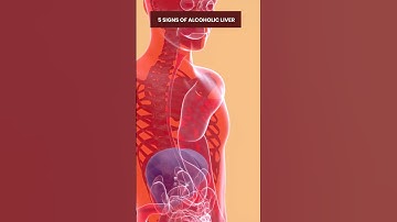 Silent Signs of Liver Cancer ⚠️ Early Symptoms of Fatty Liver & Cirrhosis You Should Never Ignore