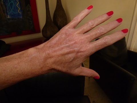 How To Get Rid Of Bulging Veins On Hands Naturally How To Get Rid Of Bulging Veins On Hands Naturally