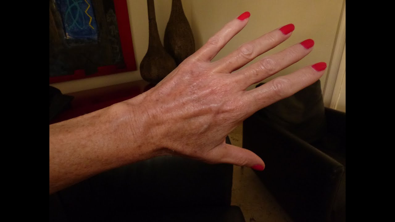 Hand Vein Treatment - YouTube
