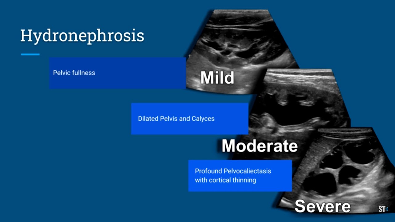 Hydronephrosis Ultrasound YouTube Hydronephrosis Ultrasound YouTube