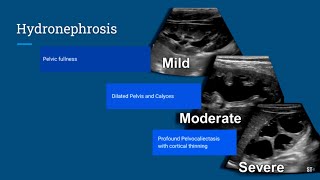 Hydronephrosis Ultrasound