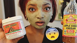 Aztec Indian Healing Clay Mask + Hormonal Acne Journey & Pics