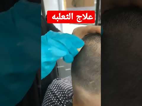 علاج الثعلبه بالثوم