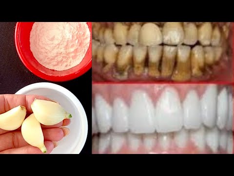 Λεύκανση δοντιών στο σπίτι σε 2 λεπτά. Πώς λευκαίνεις φυσικά τα κίτρινα δόντια σου;