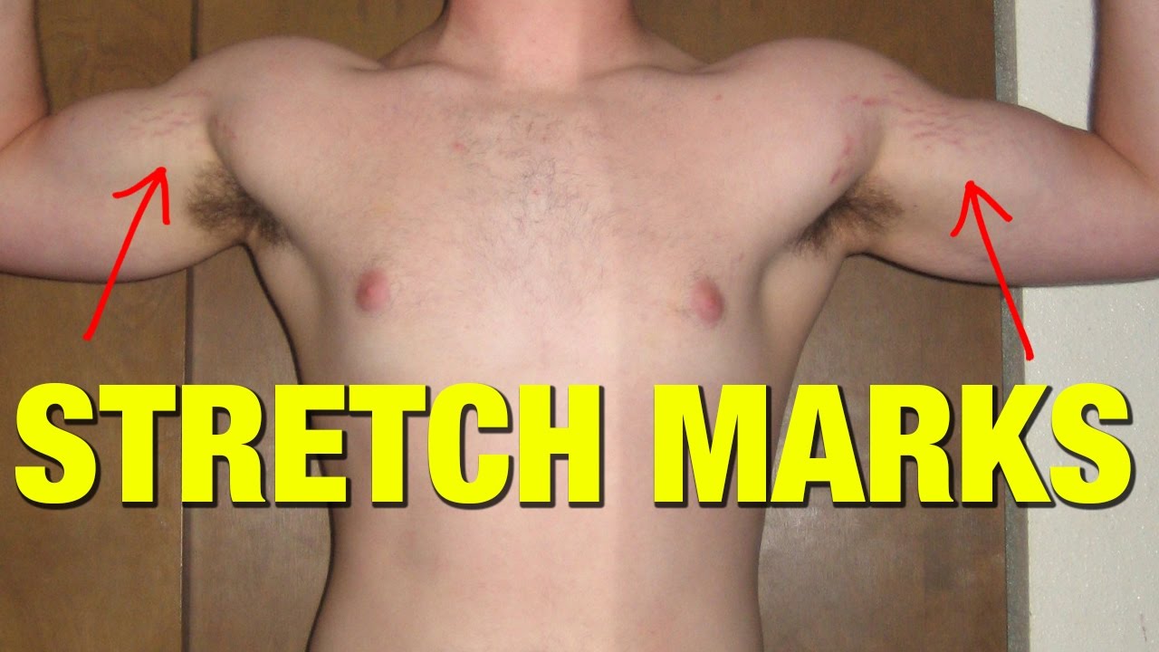 stretch marks men removal