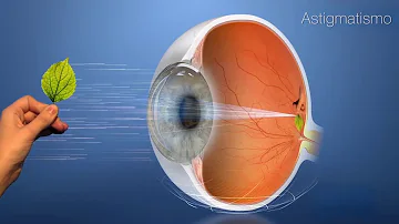 ¿Cómo se ven las farolas con astigmatismo?