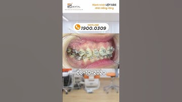 Hành trình LỘT XÁC nhờ niềng răng của khách hàng Hồng Nhung