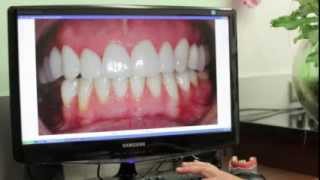 Odbudowa zniszczonych i startych zębów - studium przypadku (7)