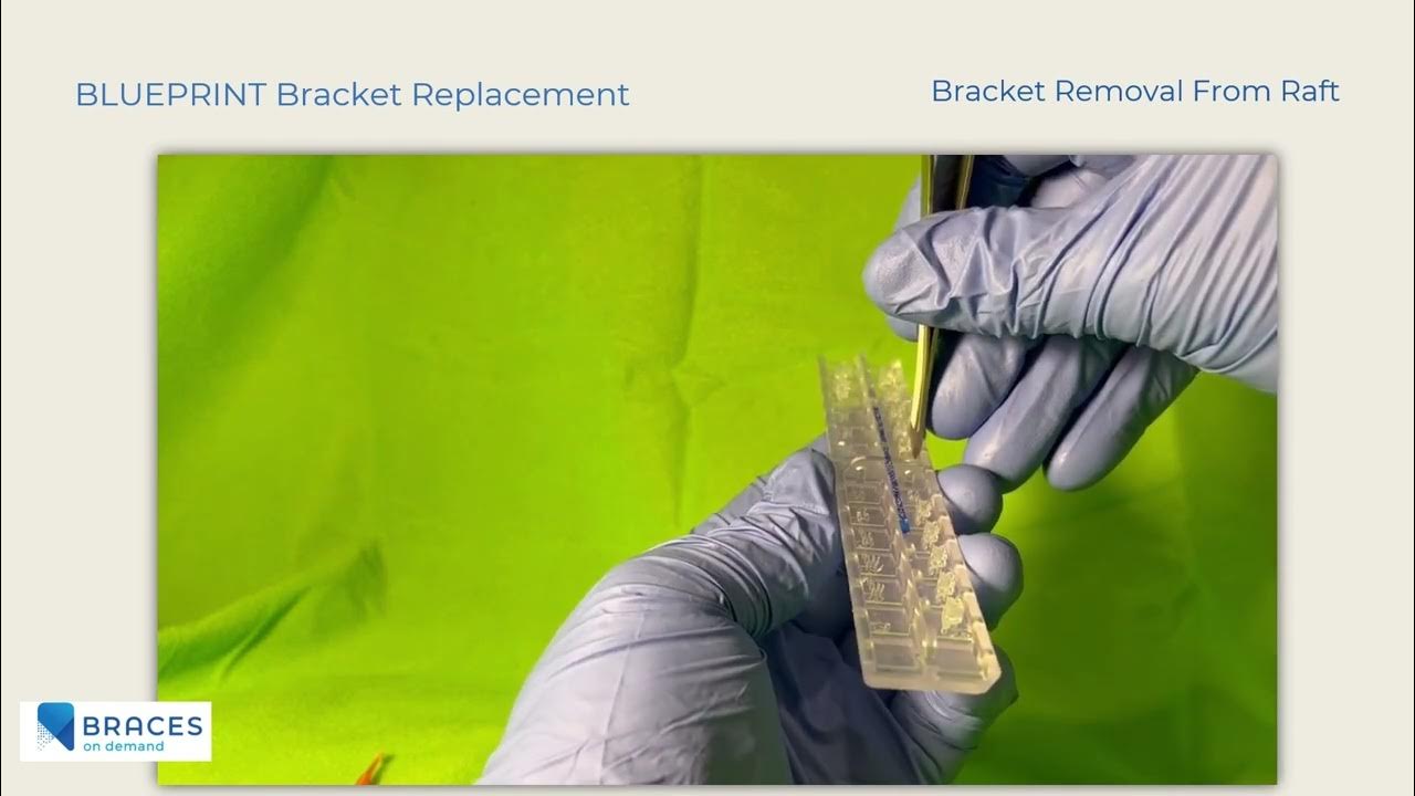 Braces On Demand BLUEPRINT Bracket Replacement Instructions YouTube