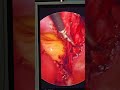 total laparoscopic hysterectomy
