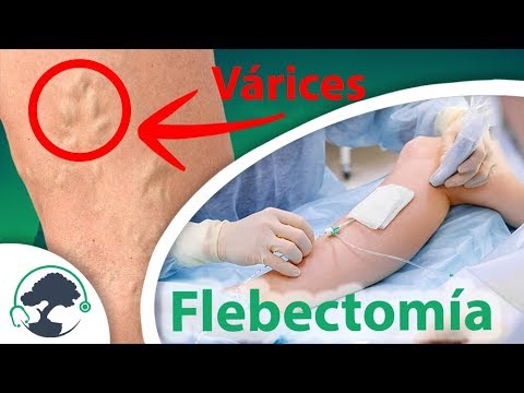 Video: ¿Cómo hacer una flebectomía?