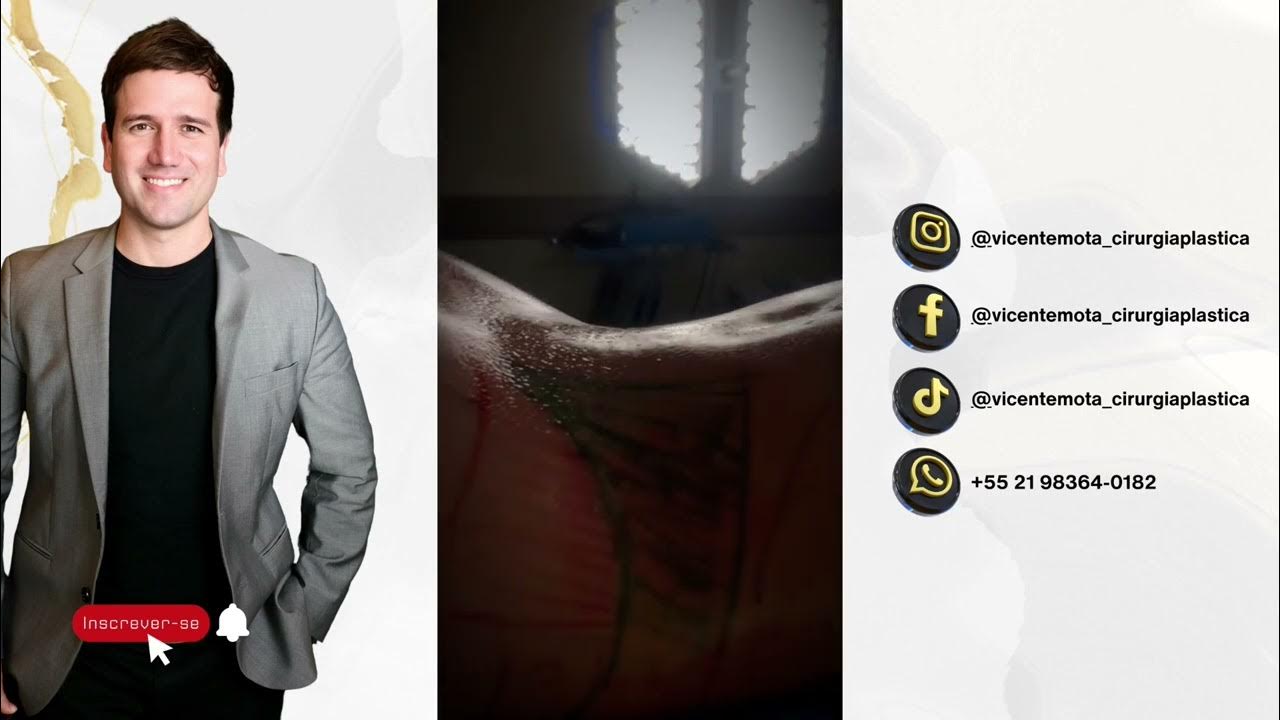 Lipoescultura Back Shape + Lipo HD YouTube