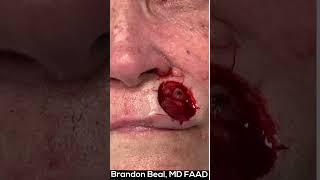 Mohs Lip Repair St. Louis Dermatology & Cosmetic Surgery