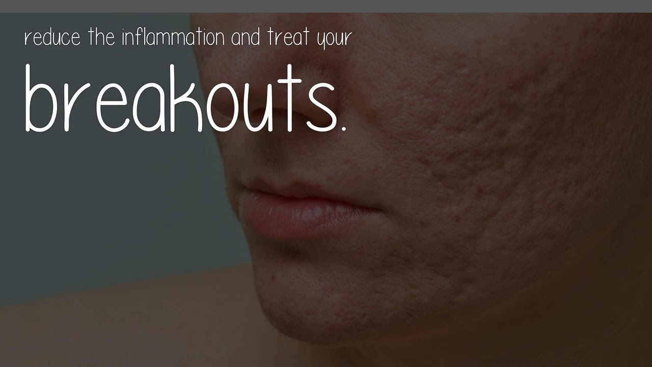 What Are The Consequences Of Using Vicks To Treat Your Acne?