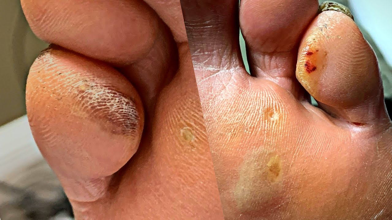 Callus vs Wart (and Corns) - Pinch Callus Removal