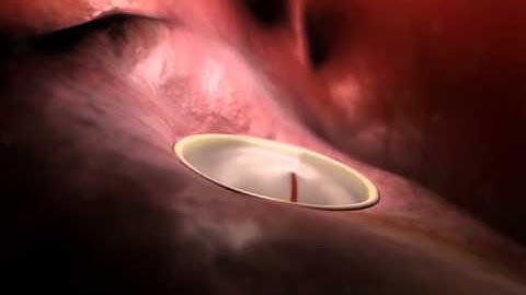 Mitral Valve Prolapse: Learn@Visible Body