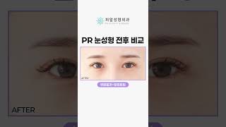 [피알성형외과] 눈성형 전후 비교｜부분절개+앞윗트임