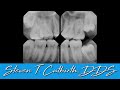 Extraction of 4 Impacted Wisdom Teeth - Dental Minute with Dr. Steven T. Cutbirth, DDS