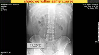 CASE 64 IVP Delayed faint persistent left nephrogram