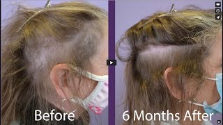 53  year Old Female with Hair Loss on the sides and back