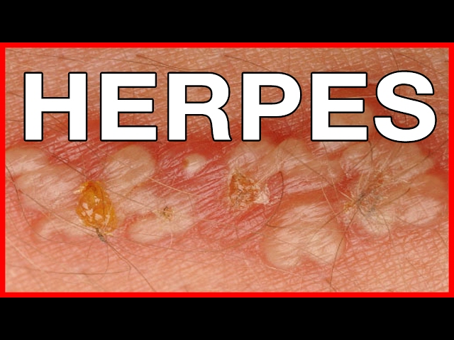 Suggest you sores around the anus matchless Sores around the anus