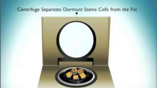 Harvesting of Stem Cells