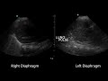 "The Lung Pulse" atelectasis from Right Mainstem Endo-Bronchial Intubation