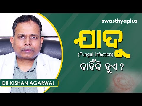 ଯାଦୁ କେମିତି ବ୍ୟାପେ? ଜାଣନ୍ତୁ ଚିକିତ୍ସା | Dr Kishan Agarwal on Fungal infection in Odia