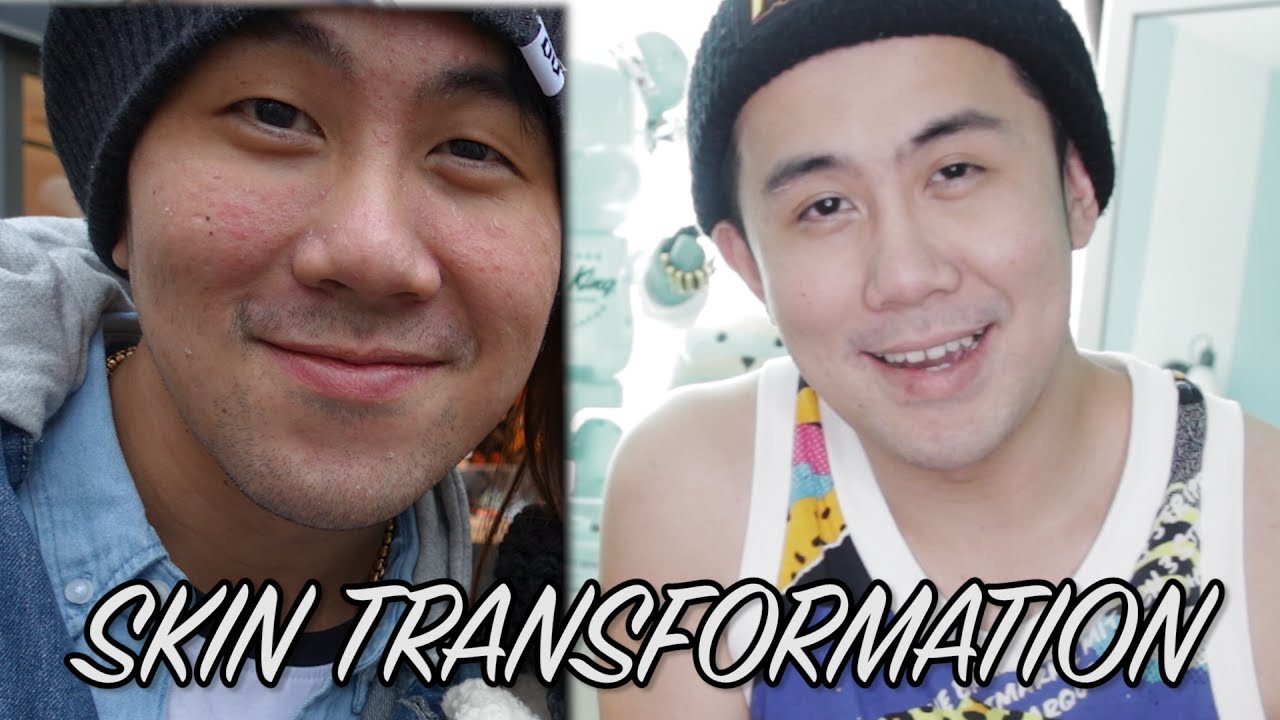 How I cured his skin! Skin redness, dry, & sensitive skin ft. Joseph Germani | SKIN TRANSFORMATION