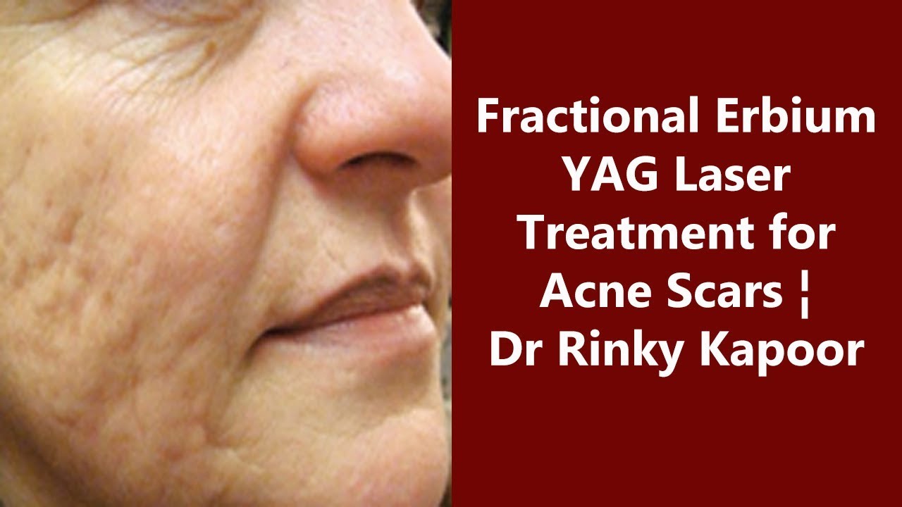 Acne Scars Removal by Fractional Erbium YAG Laser Treatment The