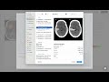 Autogon labelcraft on brain ct scan