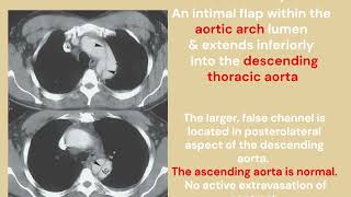 Aortic dissection Stanford type B/DeBakey III