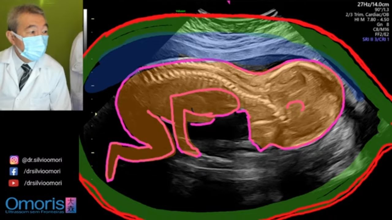 Ultrassom 21 semanas