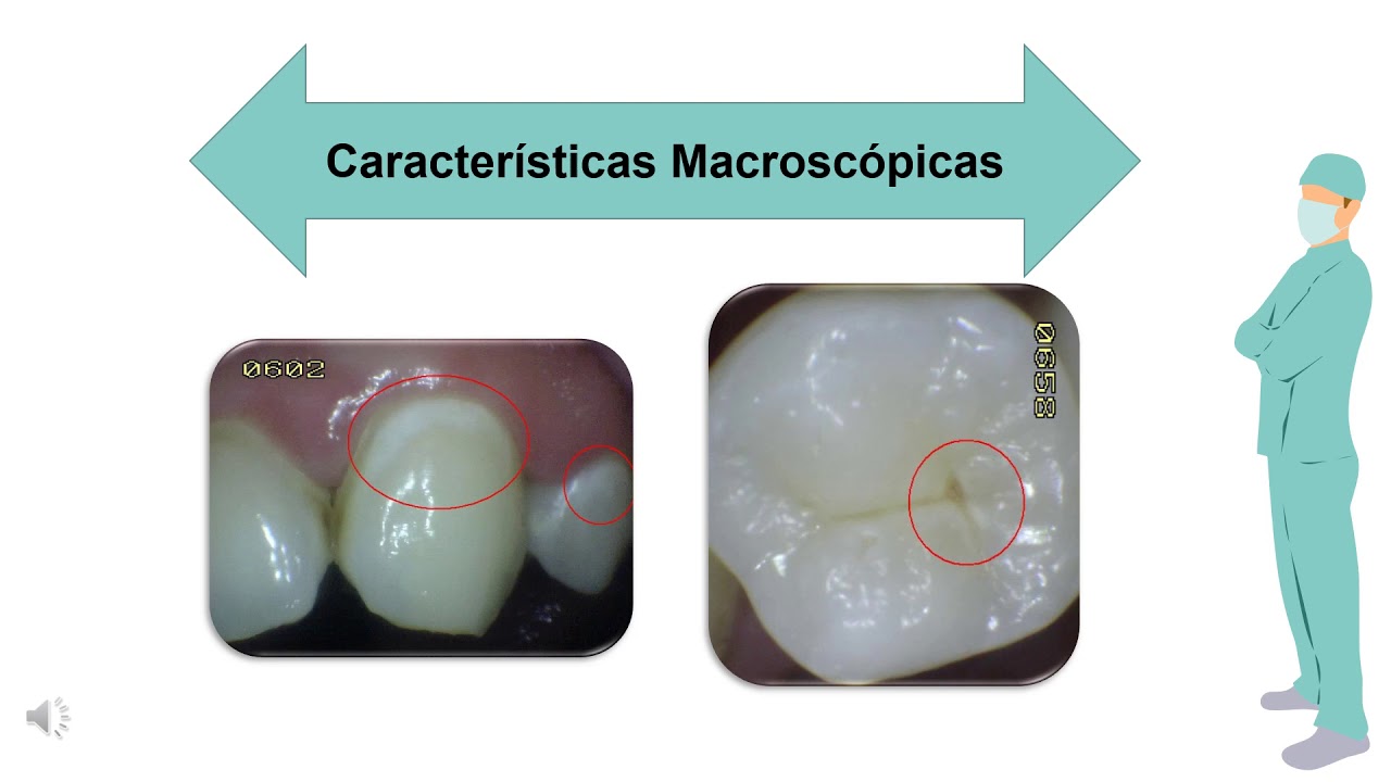 Caries de Esmalte