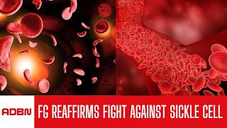 FG Reaffirms Commitment To Tackling Sickle Cell Disease