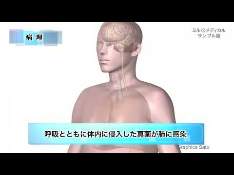 真菌性髄膜炎／ミルメディカル 家庭の医学 動画版