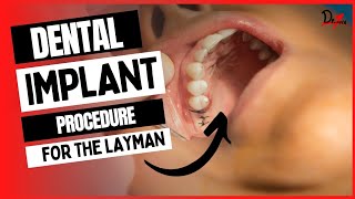 Dental Implant Procedure for the Layman!