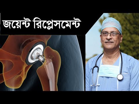 ভিডিও: একটি বল জয়েন্ট প্রতিস্থাপনের খরচ কত?