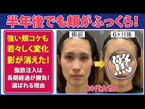 【症例紹介】友達にコケを指摘された...｜1回で驚愕のビフォーアフター