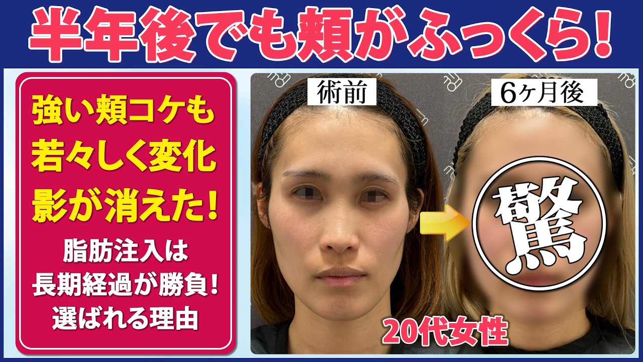 【症例紹介】友達にコケを指摘された...|1回で驚愕のビフォーアフター