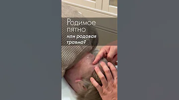 Родимое пятно на затылке на самом деле родовая травма атланта! Акупрессура подзатылочных мышц