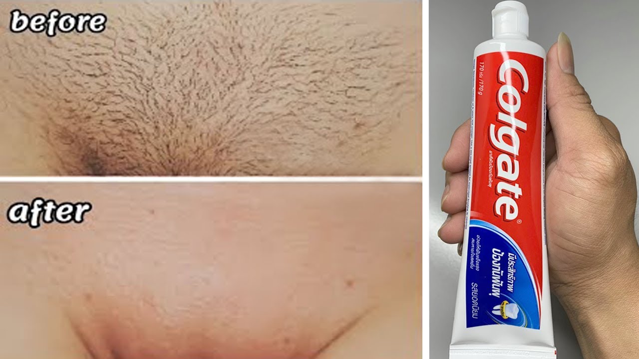 Stop shaving! Here's how to permanently get rid of unwanted hair
